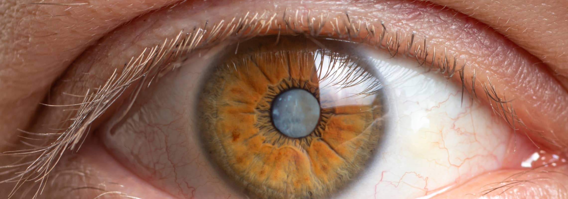 Cataracte : peut-on l’éviter | Dr Berthon | Lyon